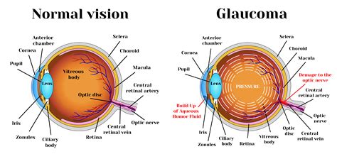 how is glaucoma detected